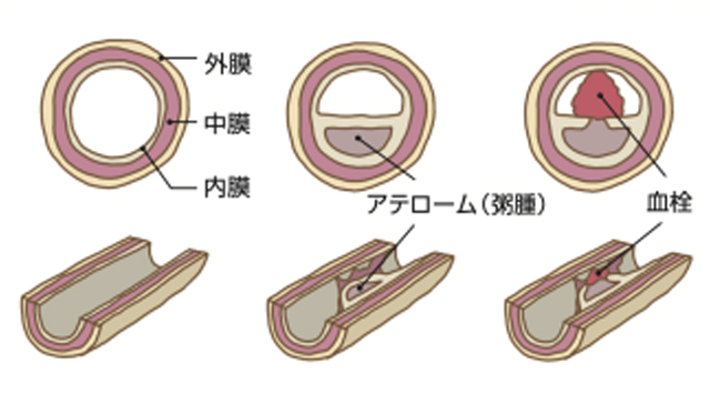 動脈硬化の経過イラスト