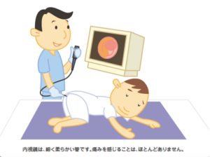 大腸内視鏡検査のイラスト