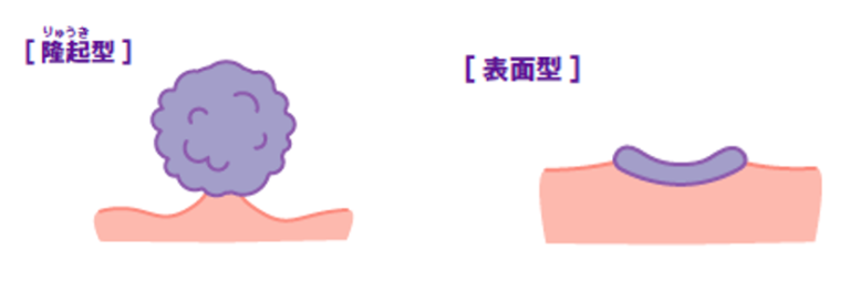 大腸がんの種類形態