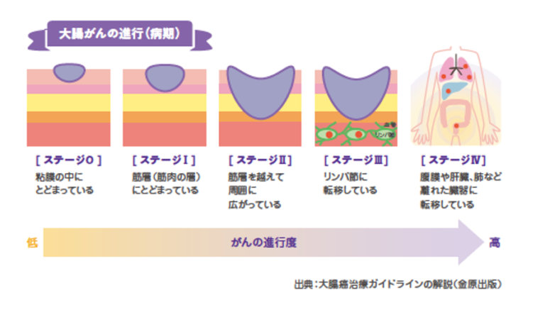 大腸がんの進行解説イラスト