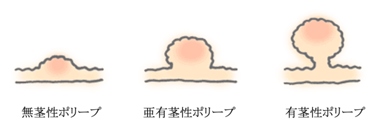 大腸ポリープの種類