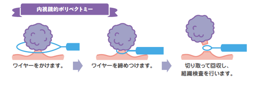 ポリペクトミーイラスト