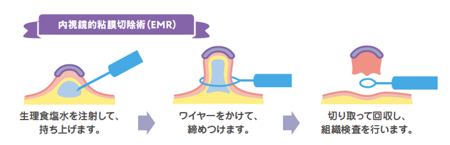 内視鏡的粘膜切除術(EMR)イラスト