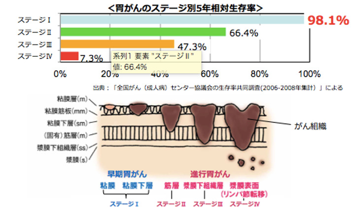 胃がんのステージ別5年相対生存率