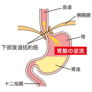 胃酸の逆流、逆流性食道炎の解説イラスト